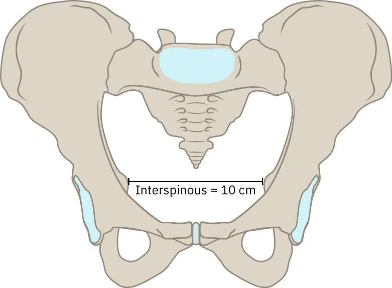 Image of pelvic bone with ischial spines extending out into the pelvic inlet. The interspinous measurement of 10 cm is labeled inside the pelvic inlet.