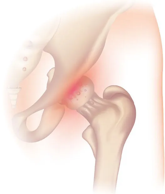 Diagram showing osteoarthritis of the hip joint