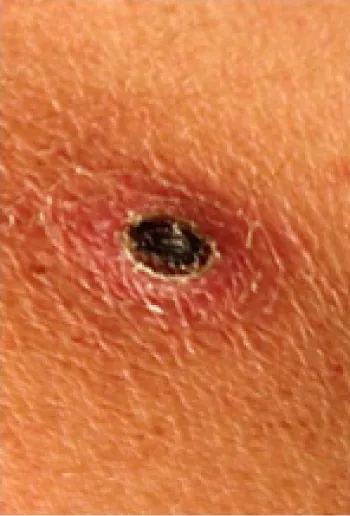 Image showing eschar.