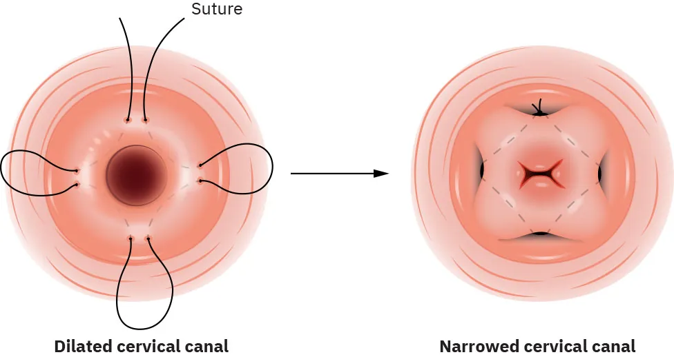 Diagram showing cervical cerclage: dilated cervical canal with sutures; narrowed cervical canal.