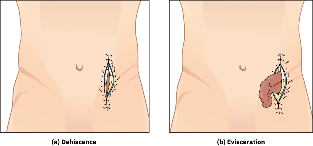 Image showing the complications of dehiscence and eviseraction.