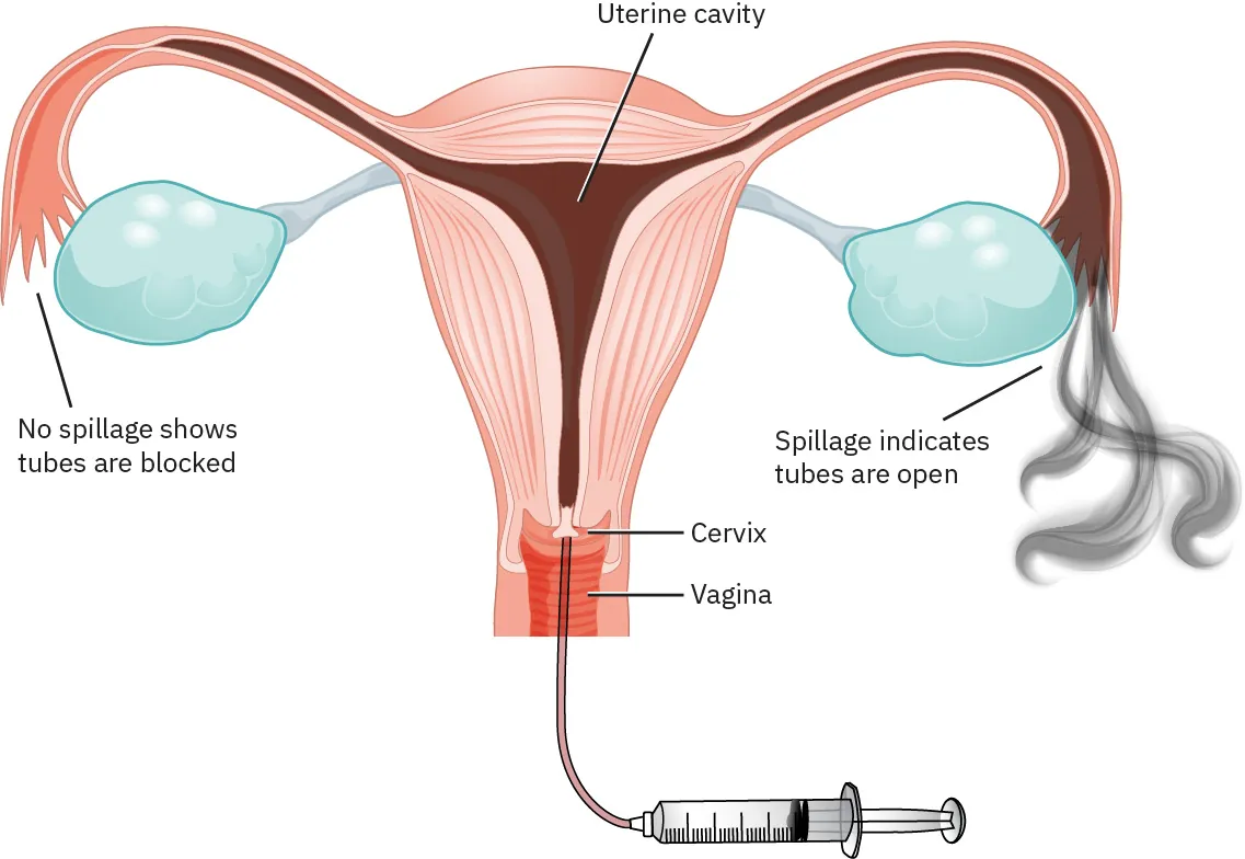 Image of uterus showing dye being injected through cervix. Fallopian tube on one side shows no spillage (tubes are blocked) and spillage on the other side (indicating tubes are open).