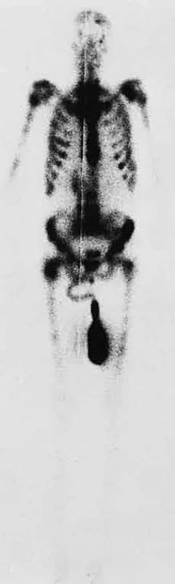 A skeletal image of a human body is shown. The image represents gamma rays emitted by nuclei in a compound that is concentrated in the bones and eliminated through the kidneys. Some parts of the image are darker than the others. The ribs are shown darker than the leg and hand bones.