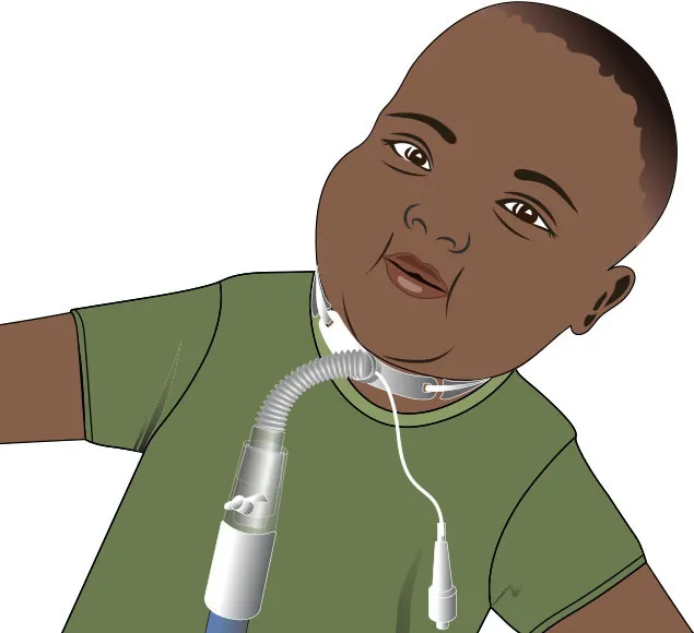 Illustration of an infant with a tracheostomy tube in place around the neck. The tube is attached to a ventilator.