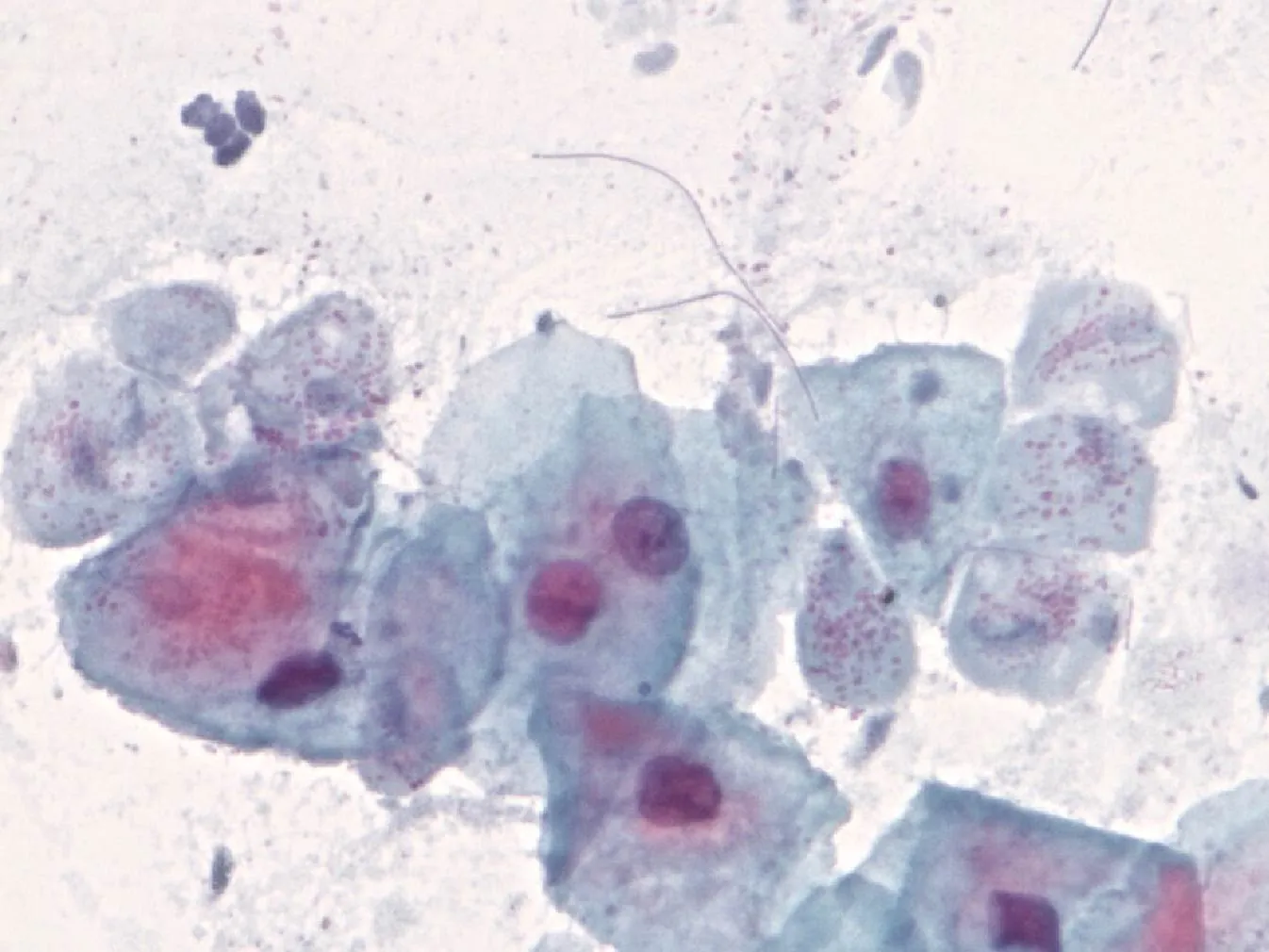 Trichomonas vaginalis, Pear-shaped microorganisms, with evident nucleus, loose and forming groups.
