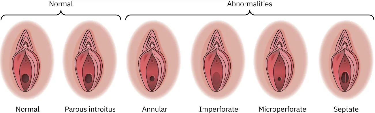Images of Normal (normal, parous introitus) and Abnormal (annular, imperforate, microperforate, septate) vaginal septum variations.