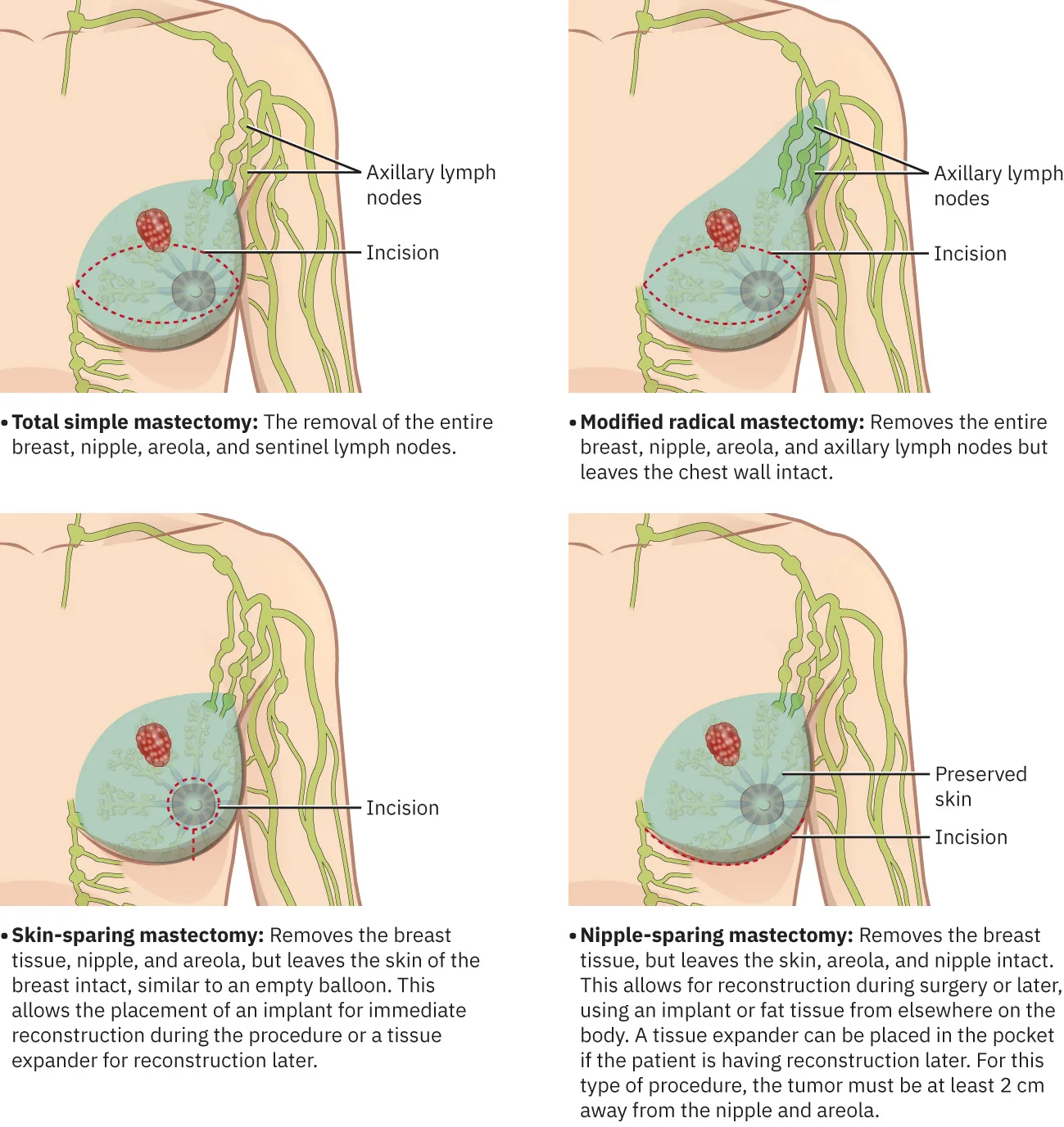 Images of (a) simple mastectomy (eye shaped incision), (b) modified radical mastectomy (eye shaped incision), (c) skin-sparing mastectomy (round incision around nipple), and (d) nipple-sparing mastectomy (C-shaped incision under breast).