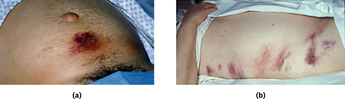 (a) Periumbilical area showing Cullen's sign. (b) Flank area showing Grey-Turner's sign.