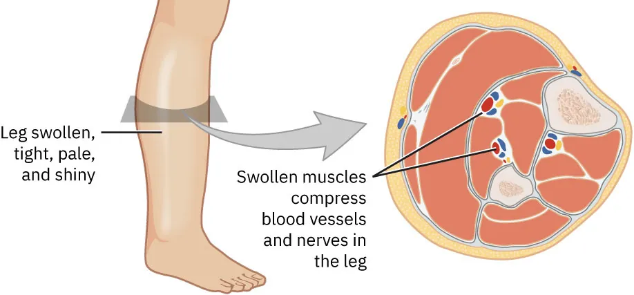 Diagram of compartment syndrome of the lower leg, labeling Leg swollen, tight, pale, and shiny, and Swollen muscles compress blood vessels and nerves in the leg