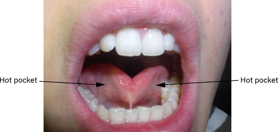 Person’s tongue labeled with hot pockets on right and left of under side.