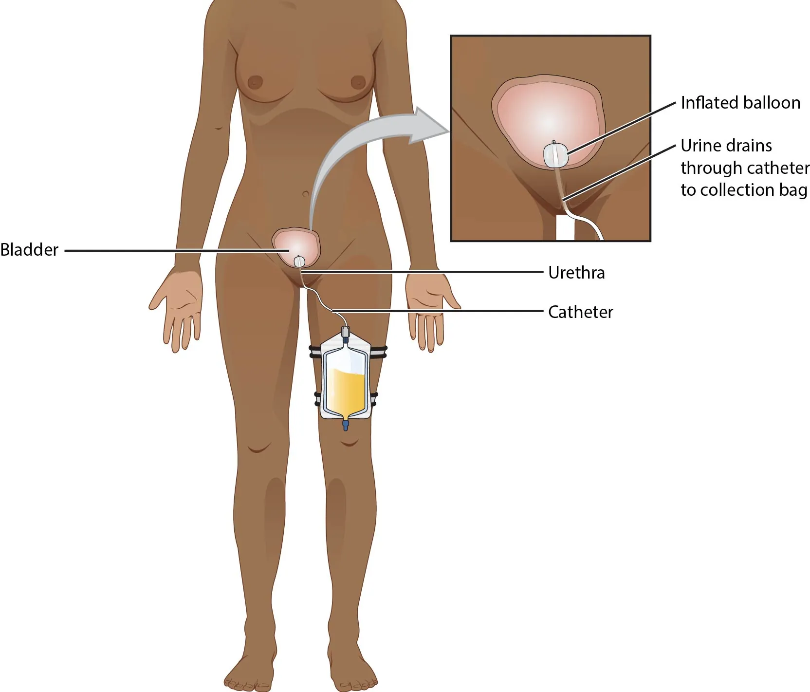 Indwelling urinary catheter.