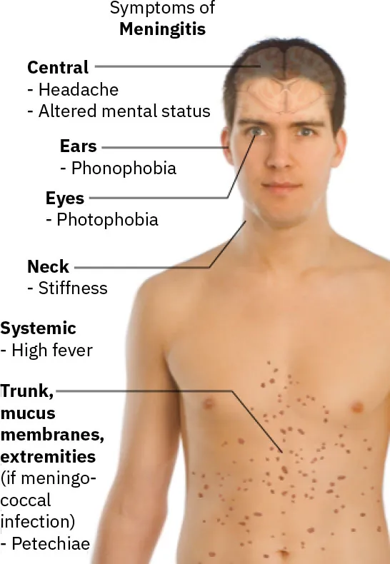 Illustration of symptoms of meningitis (torso littered with red spots): Central (Headache, Altered mental status), Ears (Phonophobia), Eyes (Photophobia), Neck (Stiffness), Systemic (High fever), Trunk, mucus membranes, extremities ((if meningococcal infection) Petechiae).