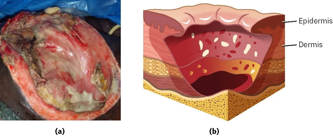 A photograph of a stage 4 pressure injury where there is loss of skin and tissue far below the dermis. There is a diagram showing the same injury.