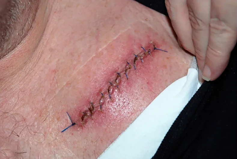 Photo of surgical incision stitches with redness and swelling.