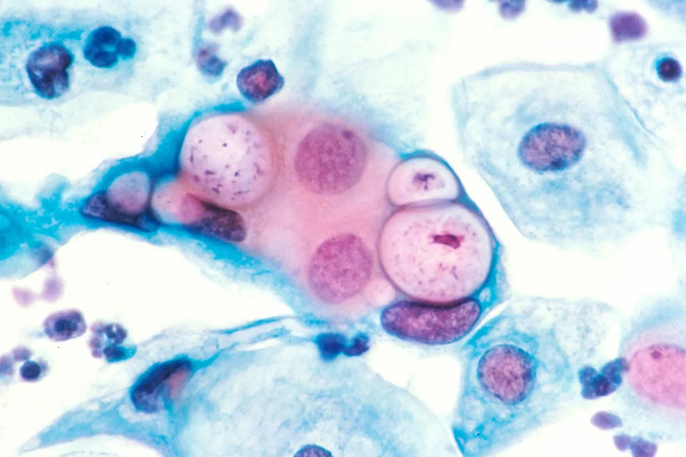 Human pap smear showing chlamydia in the vacuoles at 500x and stained with H&E.