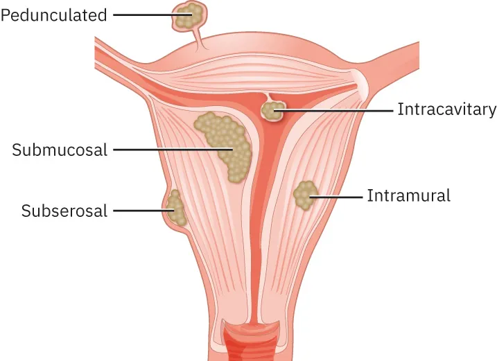 Image of uterus with various fibroids: pendunculated, intracavitary, submucosal, intramural, and subserosal.