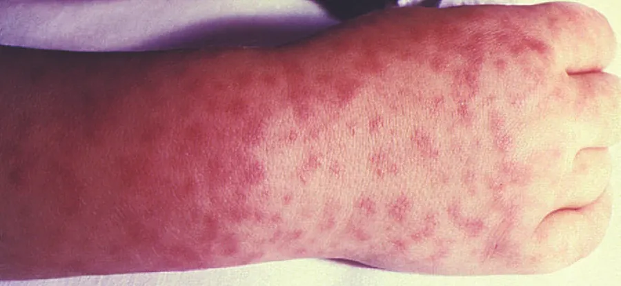 Photo of many red spots on a person’s hand.