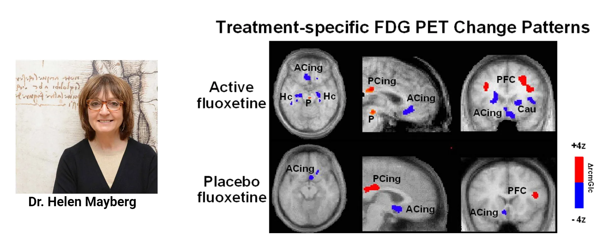 Left is a photo of Dr. Helen Mayberg, smiling. Right is a series of PET images of human brains. Colored areas indicate more or less activity in a variety of limbic areas which are similar in images from “active fluoxetine” as from “placebo fluoxetine” with only a few exceptions.
