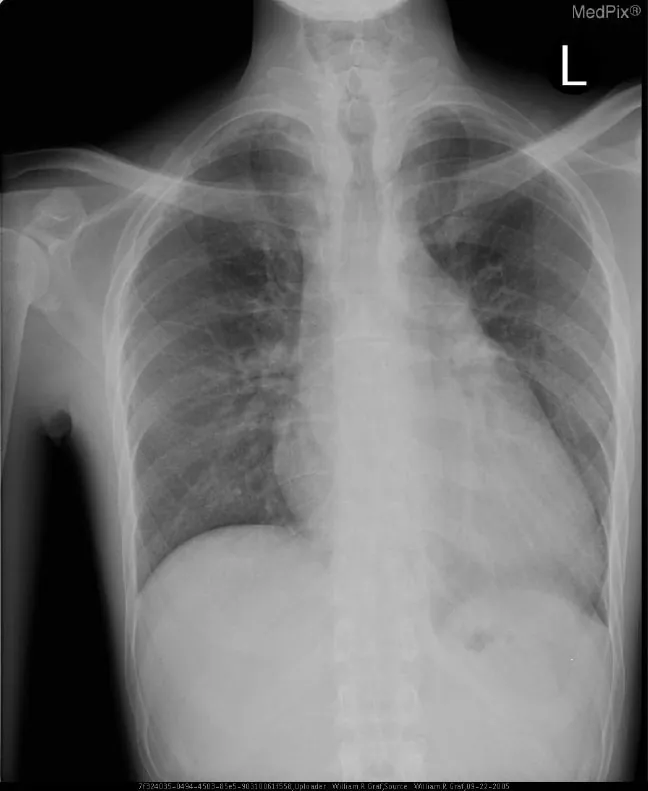 X-ray showing ventricular enlargement with apex of heart taking up right side field.