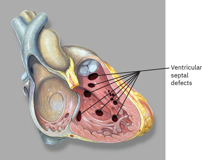 Illustration of a heart with ventricular septal defects, with arrows pointing to multiple openings in the wall separating the left and right ventricles.