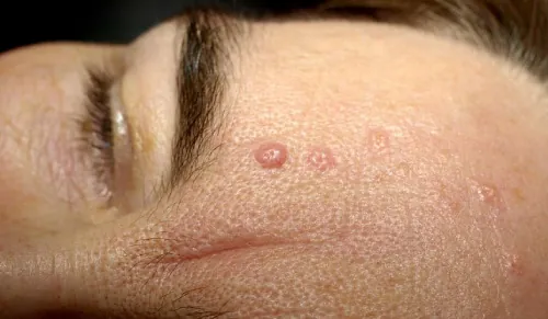 A color photograph of a face with seborrheic dermatitis