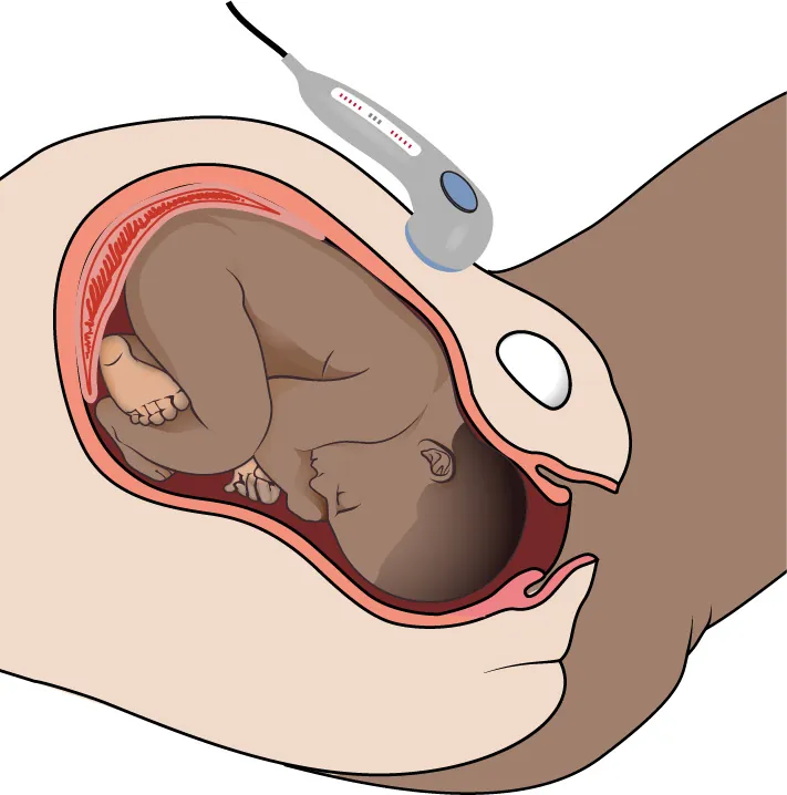 Image of fetus in utero with a vibroacoustic stimulator resting atop the abdomen.