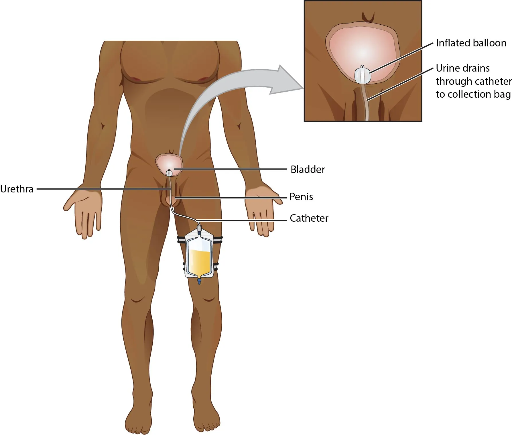 Indwelling catheter attached to a leg bag.