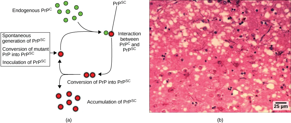 Part A illustrates how normal prion protein (PrP) is converted into the disease-causing form (PrP). PrPsc may spontaneously form in brain tissue, may be introduced when a mutant form of the protein misfolds, or may introduced into the brain tissue by inoculation. The misfolded protein causes normal PrP already present in the brain to misfold. A chain reaction occurs, leading to a large amount of misfolded protein. Part B is a light microscopy image of prion-infected brain tissue.