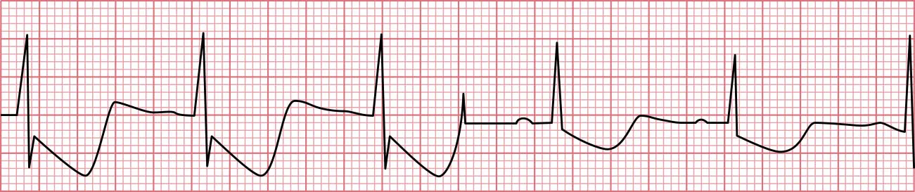 Sinus rhythm showing depression of ST segment seen in angina.