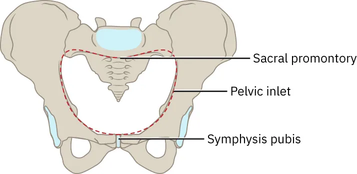 Image of pelvis bone with pelvic inlet circled.