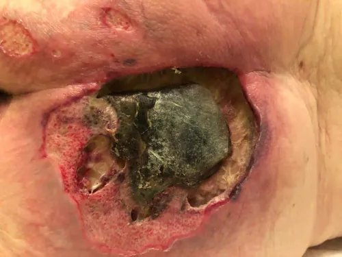 Example of a chronic wound – a bedsore.