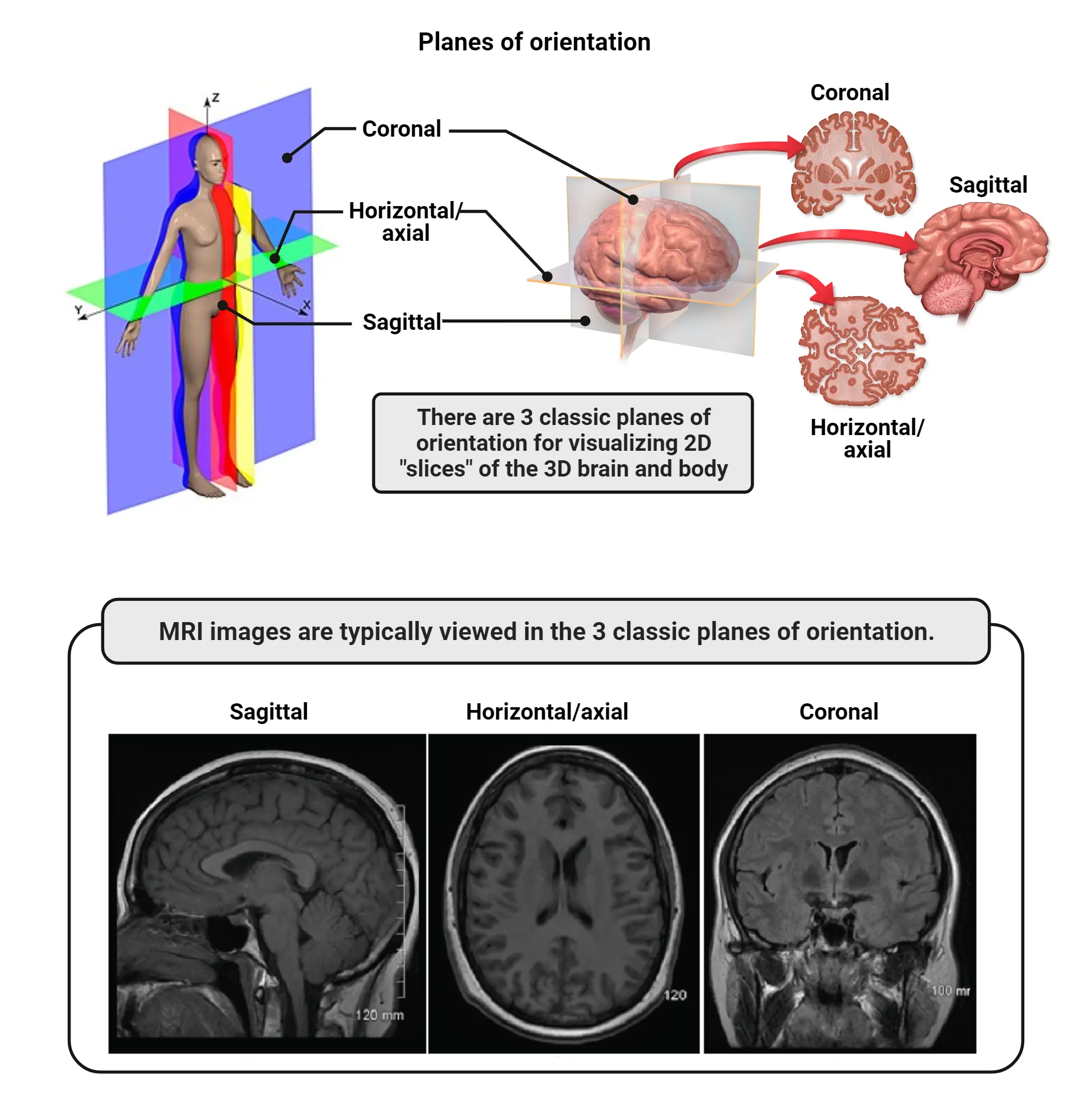 Diagrams of major anatomical planes. A human body sectioned in 3D with horizontal, coronal and saggital planes are shown. The human brain also shows 2D slices of each plane. Below, MRI images of slices of each plane are shown.