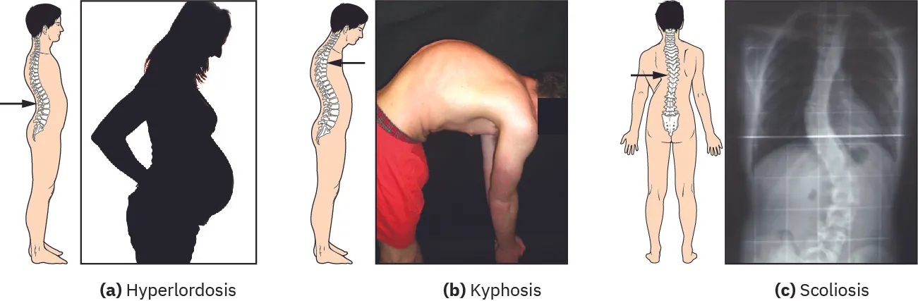 The image depicts three conditions affecting spinal curvature. On the left, an illustration and X-ray image represent scoliosis, showing a lateral curvature of the spine. In the center, a man is shown bending forward with an accentuated thoracic curve, demonstrating kyphosis. On the right, a side profile of a pregnant woman illustrates an exaggerated lumbar curve, known as lordosis. Each condition is labeled accordingly.
