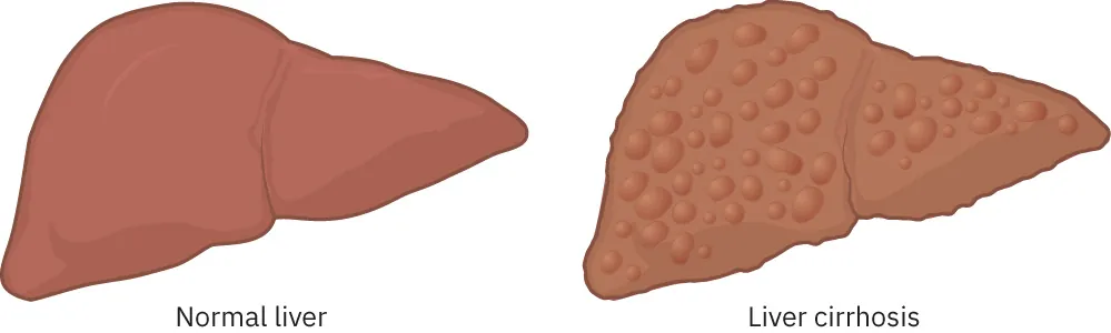 Illustration showing Normal liver and Liver cirrhosis.