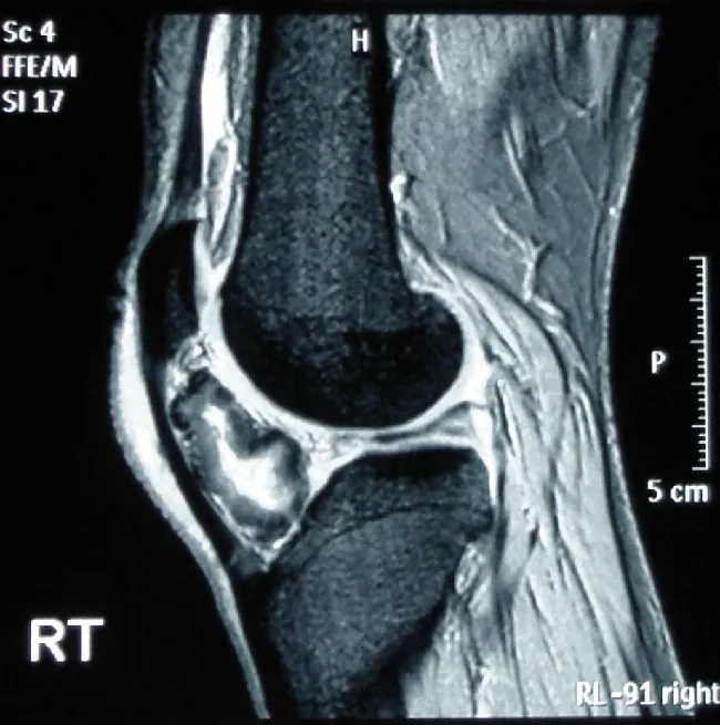 An M R I of the knee shows a high-resolution, black and white image of internal structures.