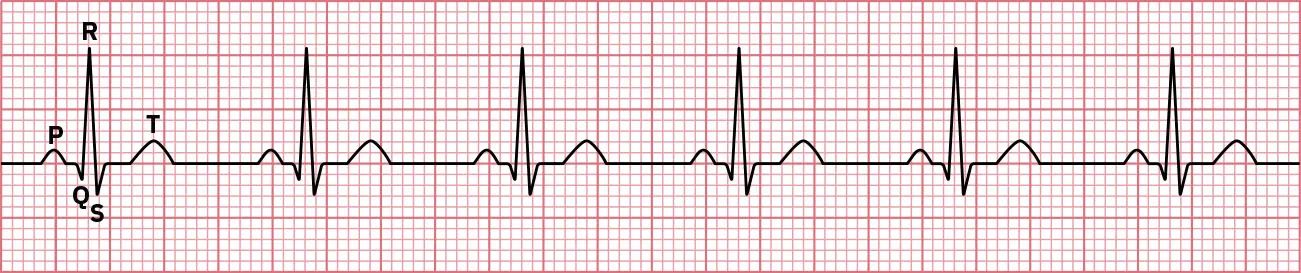 Normal sinus rhythm showing a P wave, preceding the QRS and followed by the T-wave.