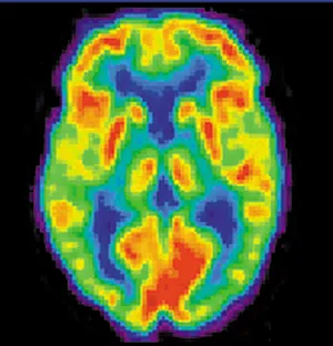 The figure shows brain image of a patient with Alzheimer’s disease.