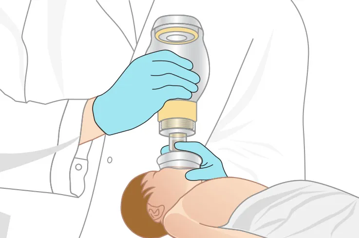 Caregiver placing a neonatal bag valve mask on a newborn.