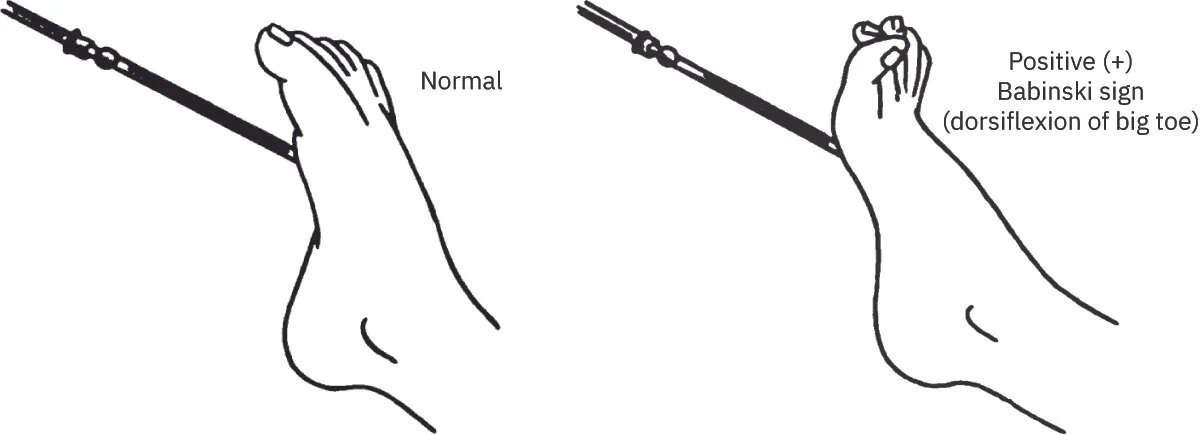 A drawn diagram shows a rod pushing into the bottom of the foot and the toes curling forward on the left and a rod pushing into the bottom of the foot and the big toe lifting up on the right.