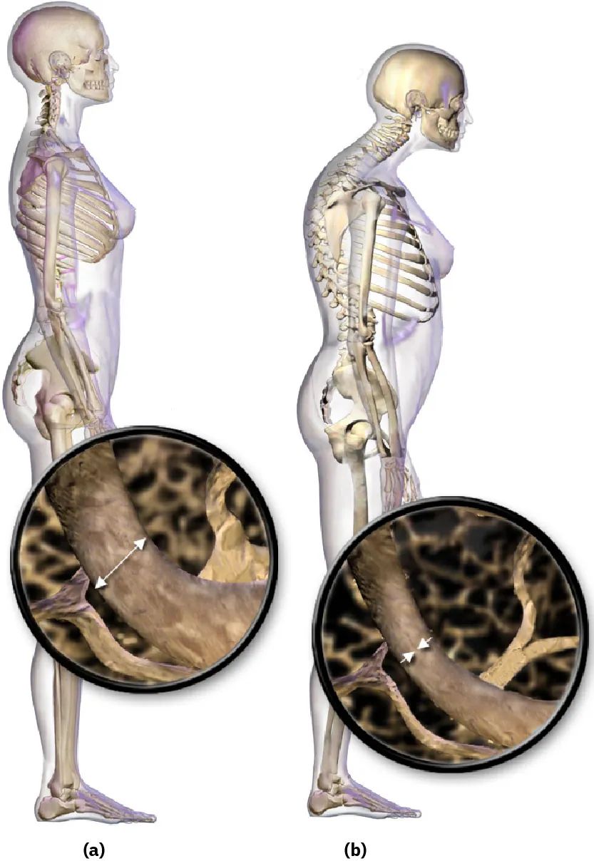 The image shows two side profile views of semi-transparent human figures with skeletons visible underneath the skin. Each figure has a magnified inset: one focuses on the bone structure of the hip joint, and the other on the spine, with arrows pointing to specific areas within the spongy bone, possibly indicating the location of bone marrow or points of clinical interest.