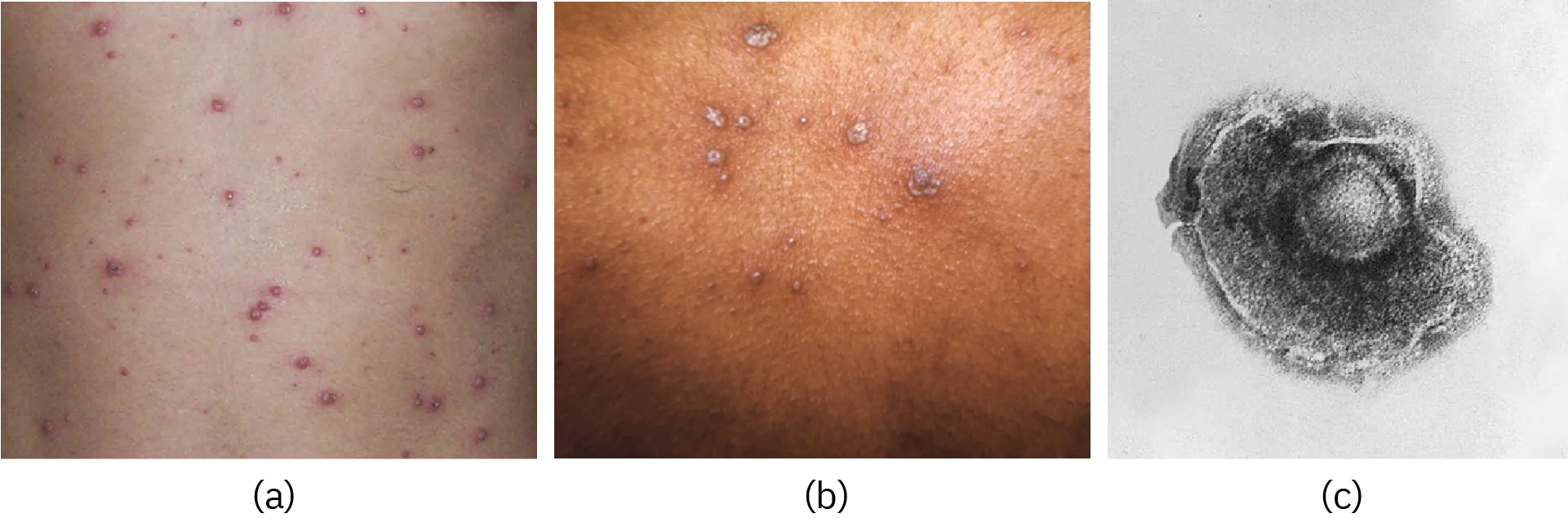 (a) and (b) red bumps on skin. (c) a micrograph of human herpesvirus 3 is shown. The diameter is approximately 300 nanometers according to a scale bar on the bottom right of the micrograph.