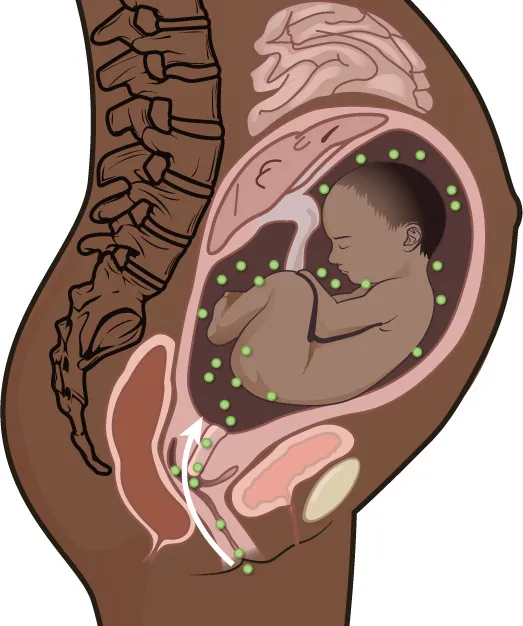 Image of infection reaching infant in utero through the vaginal canal.