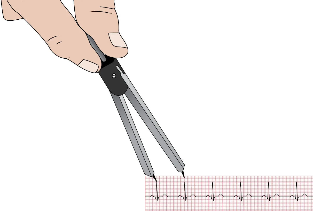 Illustration showing hand using telemetry calipers to measure the distance between P wave and R wave or the space in the QRS complex in sinus rhythm.