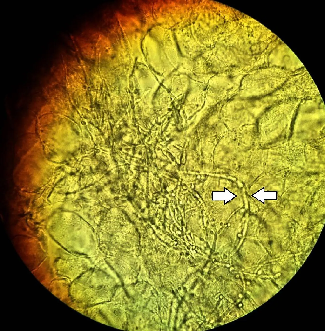 Vaginal wet mount (using a potassium hydroxide preparation and light microscopy at 40x magnification) showing slings of pseudohyphae of Candida albicans (one annotated by arrow) surrounded by round vaginal epithelial cells, conferring a diagnosis of candidal vulvovaginitis.