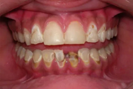 A photograph of major tooth decay in the mouth of a man. The teeth are black and brown.