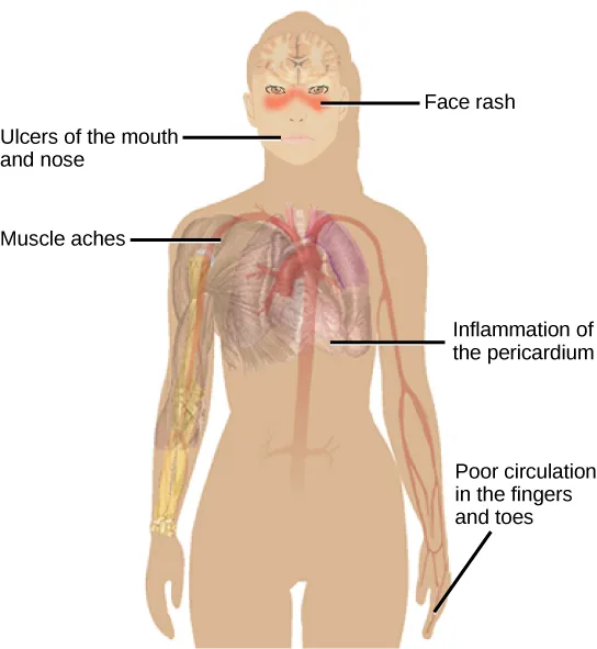 Illustration shows the symptoms of lupus, which include a face rash, ulcers in the mouth and nose, muscle aches, inflammation of the pericardium and poor circulation in the fingers and toes.