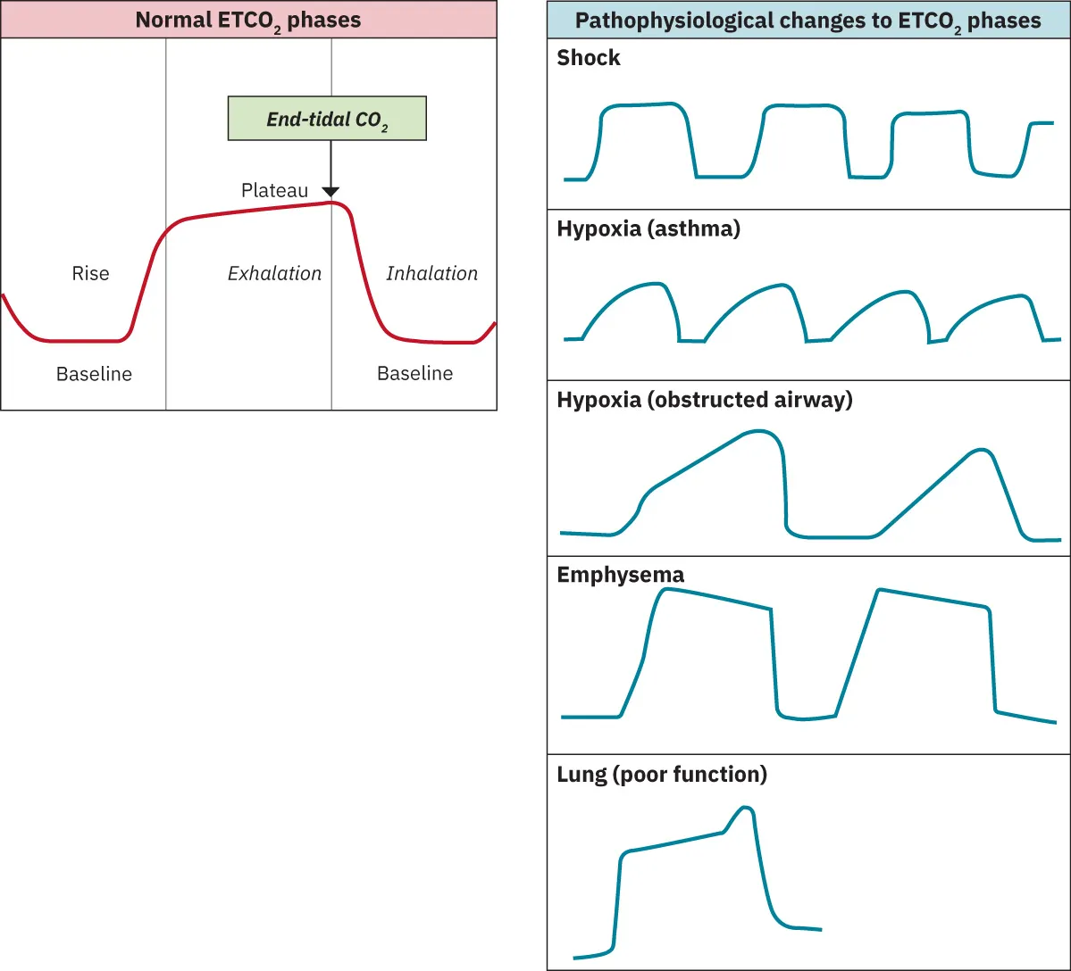 A diagram showing the normal ETCO2 waveform and respiratory phases and variations on the left side, and the waveform of different pathophysiological conditions on the right side.