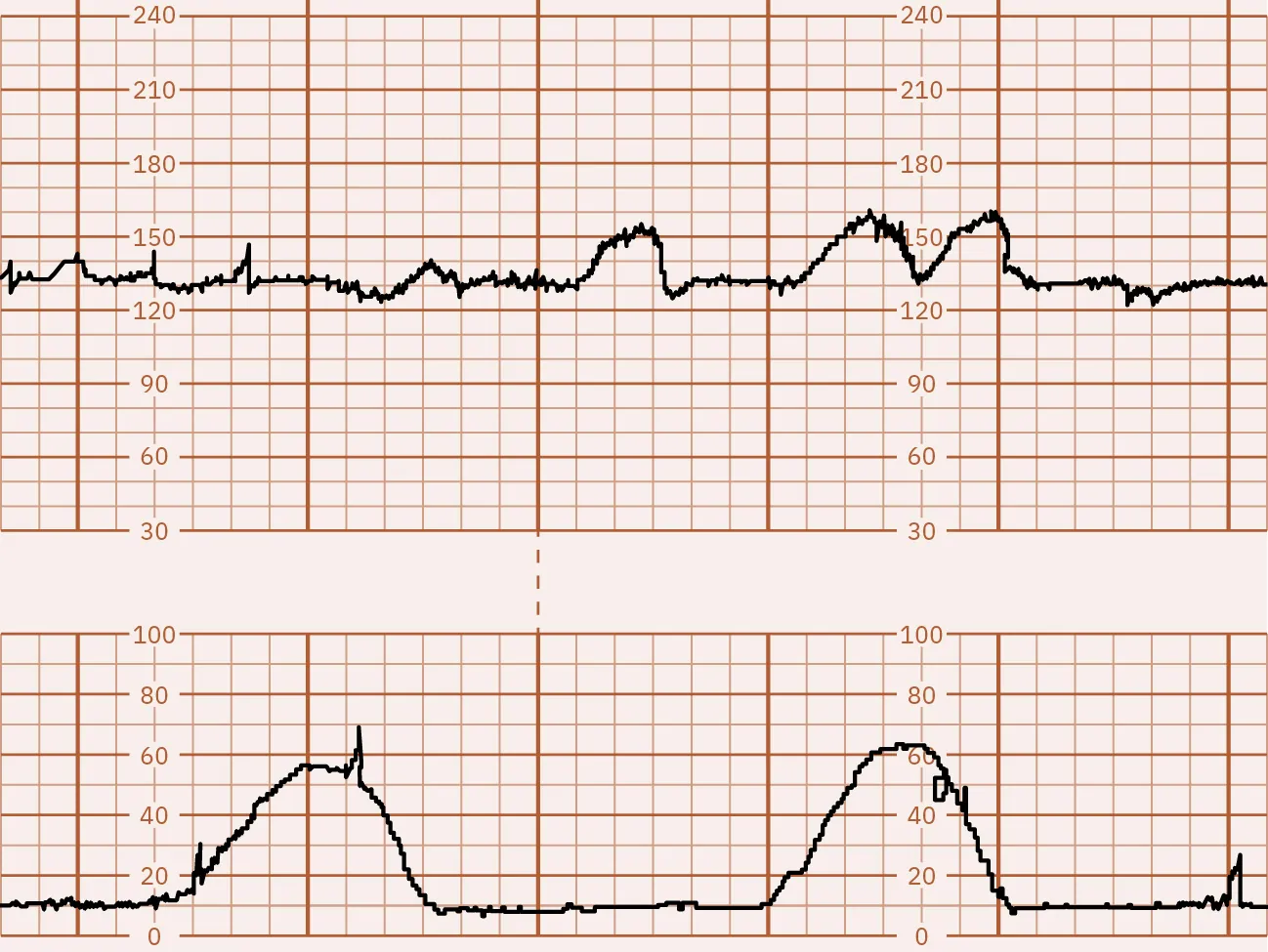 Fetal monitor tracing graphic depicting negative CST. Top strip remains stable during spikes in the lower strip.