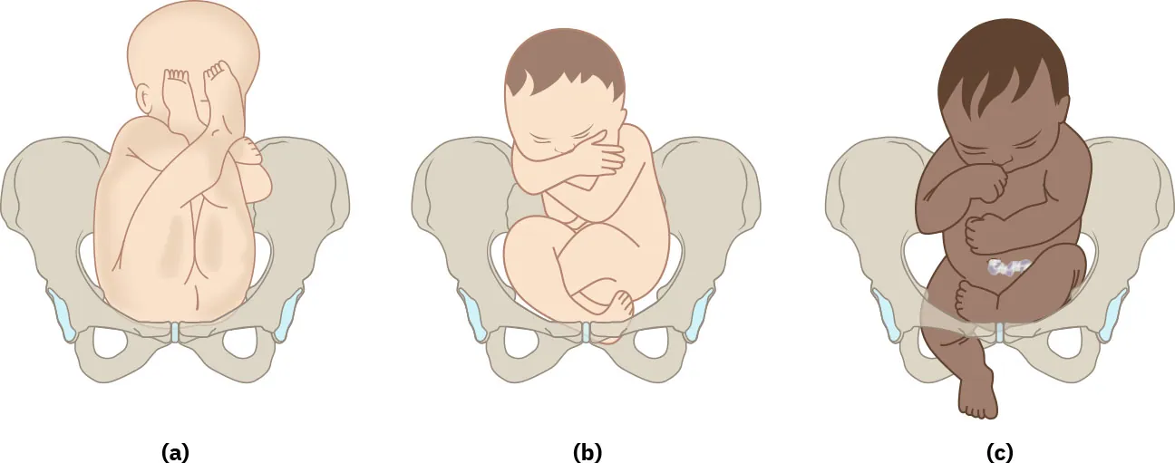 Breech positions, bottoms down, with (a) legs up/crossed in front of face, (b) arms/legs crisscrossed across body, and (c) one leg sticking out of birth canal; arms/other leg crossed across body.
