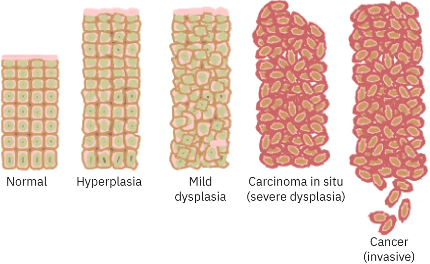 Diagram showing groups of cells: Normal, Hyperplasia, Mild dysplasia, Carcinoma in situ (severe dysplasia), Cancer (invasive)